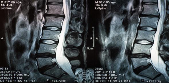 Car Accident Herniated Disc Injury Lawyers