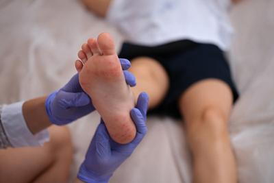 Child-with-Hand-Foot-Mouth-Disease