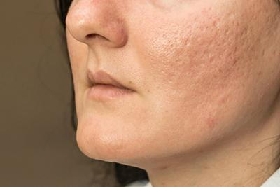 Acne-Scars-on-Woman's-Cheek