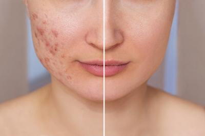 Before-and-after-image-showing-acne-treatment-results
