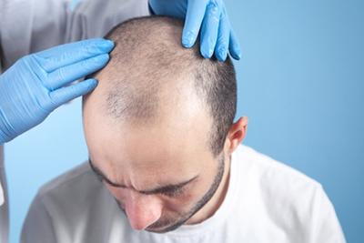 Male patient undergoing scalp examination for hair loss