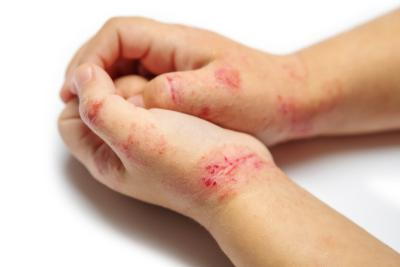 Hand with infected Psoriasis