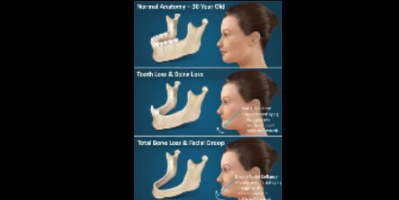dental implants ft lauderdale