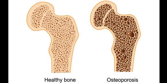 Picture of osteoporosis bone