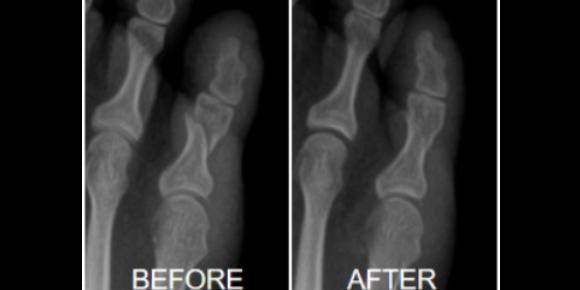 X-Ray Results Before and After Wearing Correct Toes