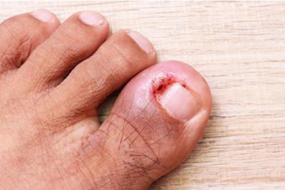 Photo-Showing-an-Ingrown-Nail