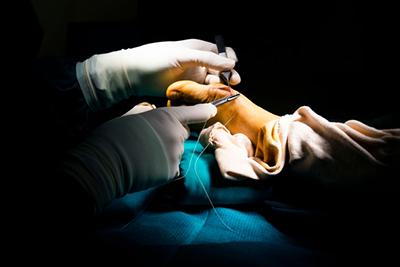 Process-of-removing-Bunions-in-foot-of-a-person.