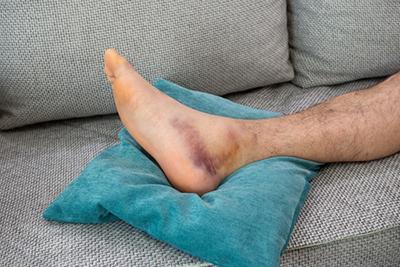 Close-up of swollen ankle resting on couch