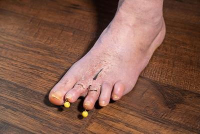 After the Hammertoe Surgery in a person.