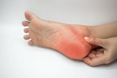 Illustration of Heel Spurs pain