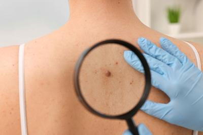 Patient's-Back-with-Mole-is-Examined-by-Dermatologist