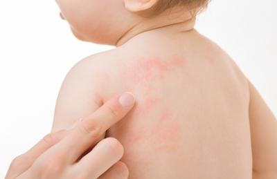 Closed-up-rashes-of-baby-in-the-Back