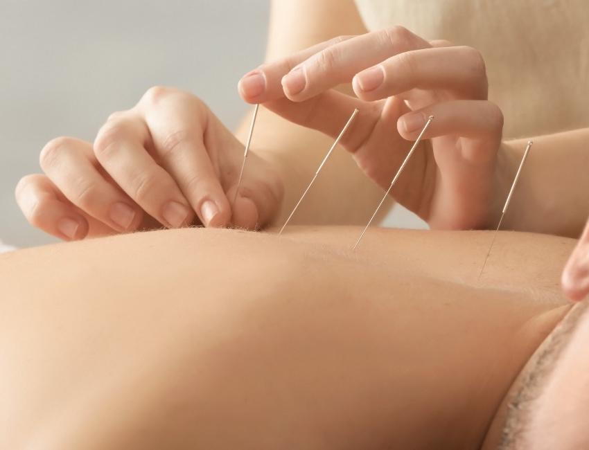 Patient receiving acupuncture from chiropractor in Nanaimo