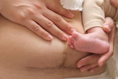 Womans tummy after csarian operation