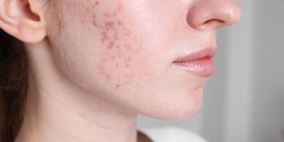 Woman-With-Acne