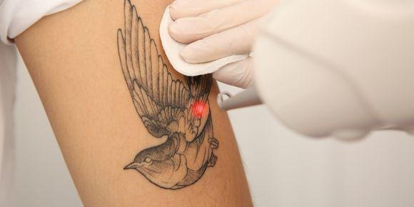 Tattoo Removal FAQs: Can You Remove a Tattoo From Anywhere?