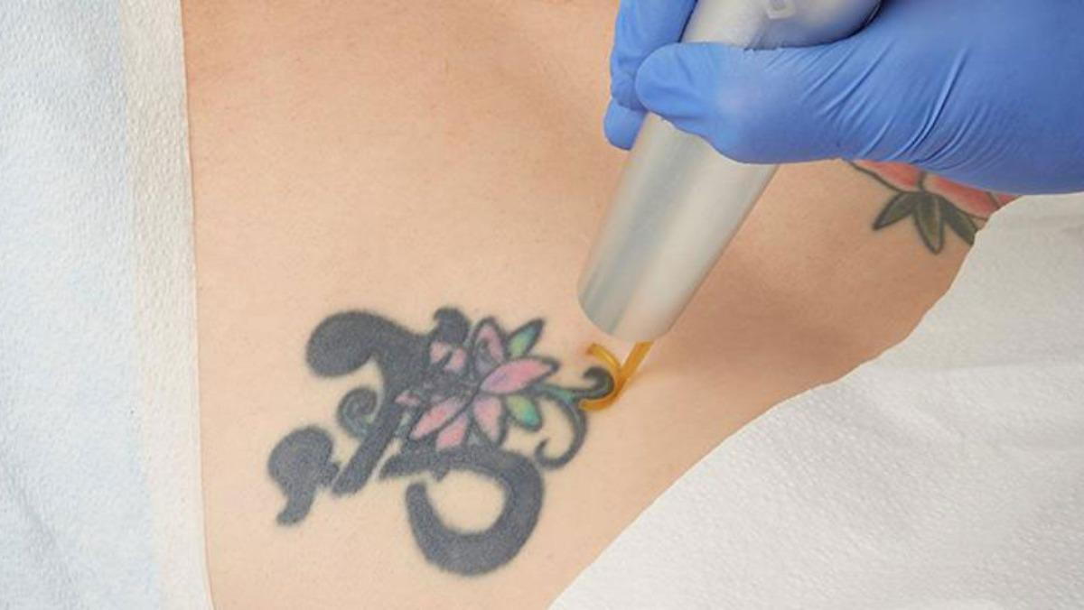 Laser Tattoo Removal  Genesis Medspa  Jefferson City Missouri