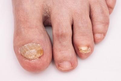 Illustration-of-fungus-toenail-in-person-foot-closed-up-image.
