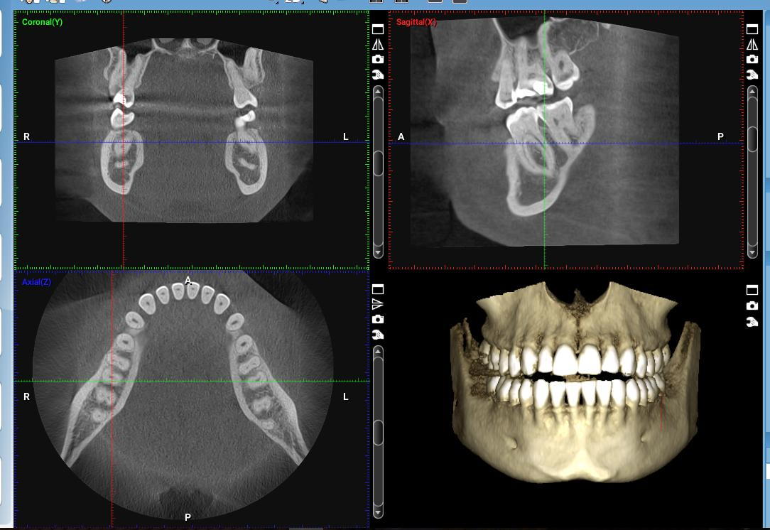 Revolutionizing Dental Implant Planning with CBCT Imaging