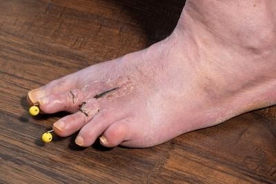 Foot showing surgical scars and pins after hammertoes surgery