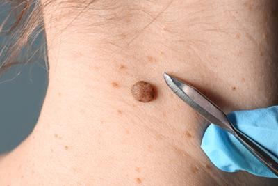 Mole-Removal-with-your-Trusted-Skin-Doctor