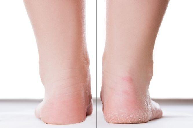 Why Are My Feet Peeling? – My FootDr