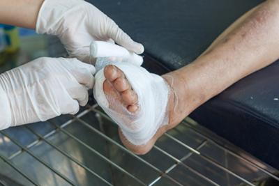 Close-up of podiatrist cleaning diabetic patient's foot wound in clinical setting