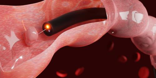 Endoscopic view of a colon polyp found during colonoscopy