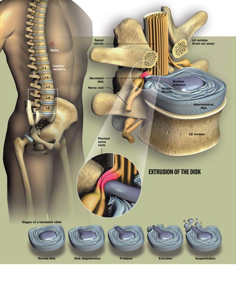 Herniated Disc - AKSIS Special Hospital