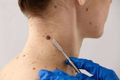 Doctor-removes-mole-from-neck-using-a-scalpel.