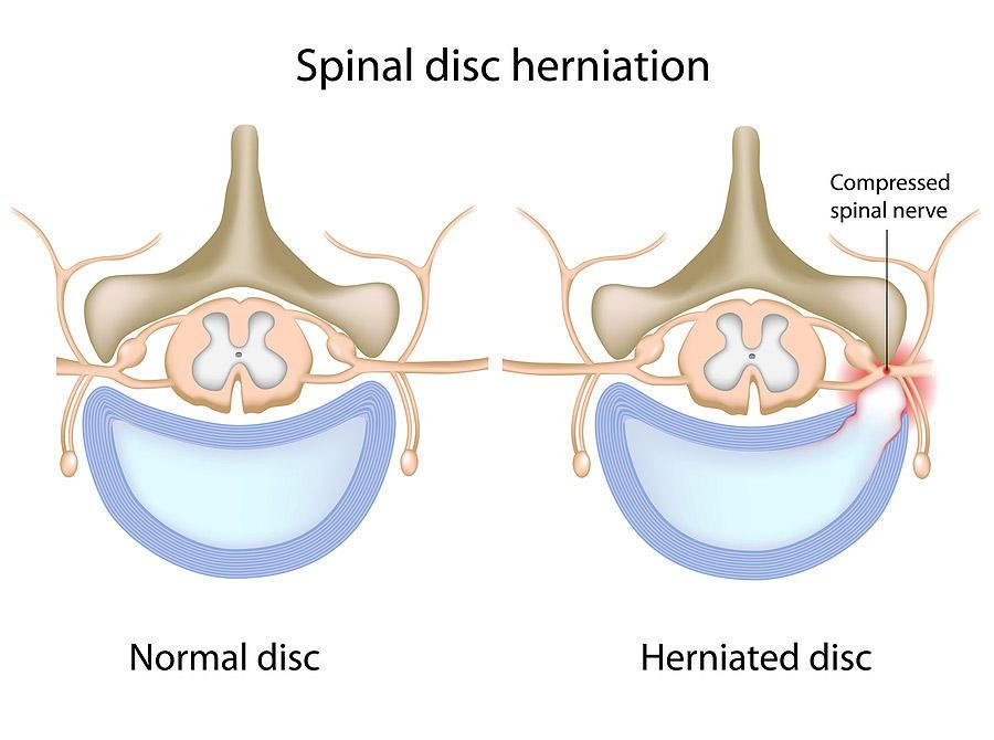 Illustration of spinal disc herniation