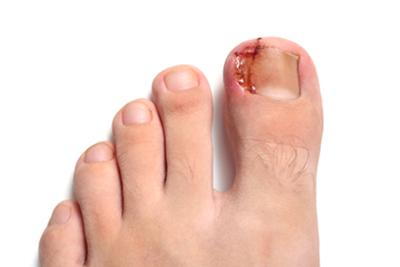 Foot-with-ingrown-Toenail