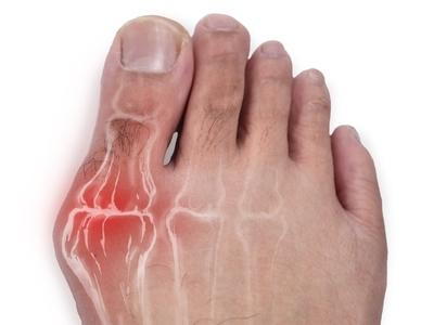 Bunions with skeletal drawing in person foot.