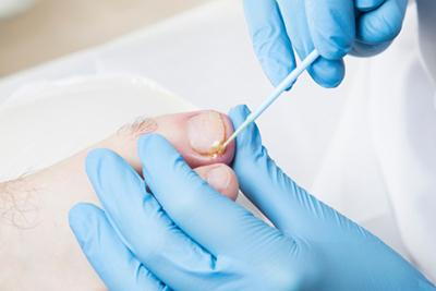 Doctor removing the Ingrown on patients foot