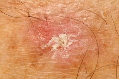 Dry skin possible for skin cancer.