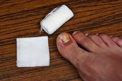 Foot showing signs of ingrown nail inflammation, with treatment supplies nearby