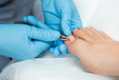 Podiatrist providing treatment for ingrown toenail