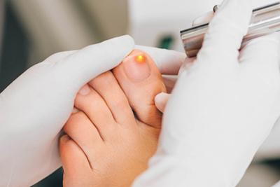 Medical procedure using laser therapy to treat toenail fungal infection