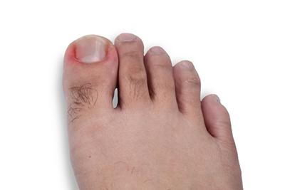 Man-with-Ingrown-Toenail-on-Right-Foot