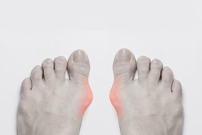 Medical image highlighting the protruding bone and toe angle associated with a bunion.