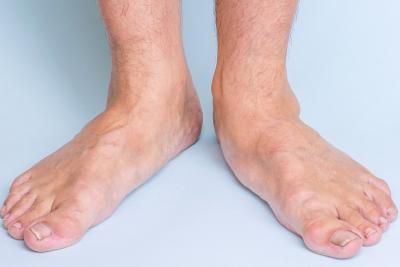 Adult male feet showing signs of flat foot disorder