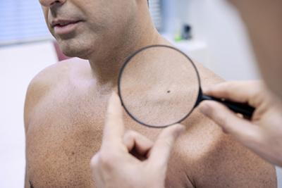 Dermatologist examining a male patient's skin for possible cancer
