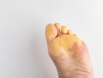 Dealing with Common Foot Problems