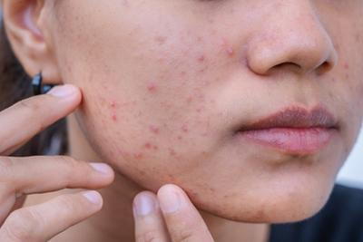 Adult Acne: Causes, Lifestyle Triggers & Effective Solutions