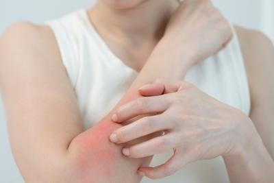 Close-up of woman scratching red irritated skin on arm indicating sensitivity