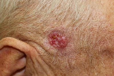 Basal-Cell-Carcinoma-on-Senior-Man