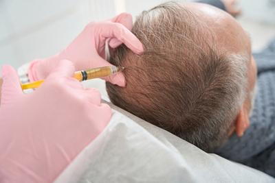 Doctor-injecting-PRP-into-man's-scalp