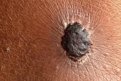 Melanoma-skin-lesion-color-black.
