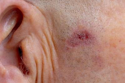Basal Cell Carcinoma skin condition