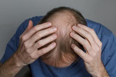 Man examining his scalp, showing thinning hair due to alopecia